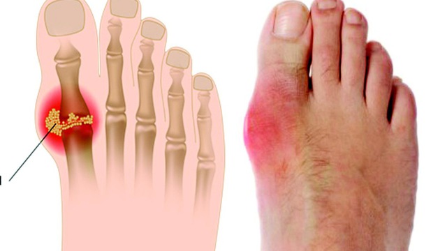 tri-gout